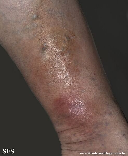 File:Lipodermatosclerosis (Dermatology Atlas 1).jpg