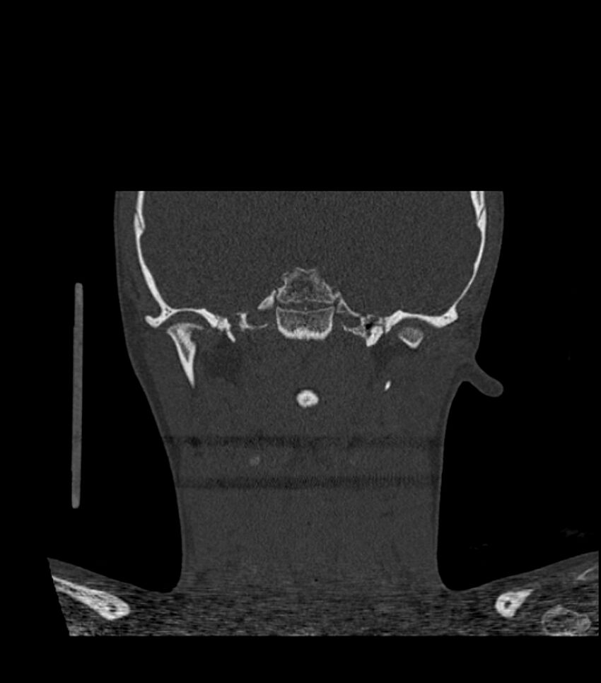Nasoorbitoethmoid fracture (Radiopaedia 90044-107205 Coronal bone window 92).jpg
