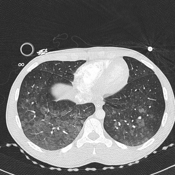 File:Near drowning (pulmonary edema) (Radiopaedia 24685-24958 lung window 64).jpg