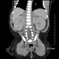 Neonatal neuroblastoma (Radiopaedia 56651-63438 Coronal non-contrast 38).jpg