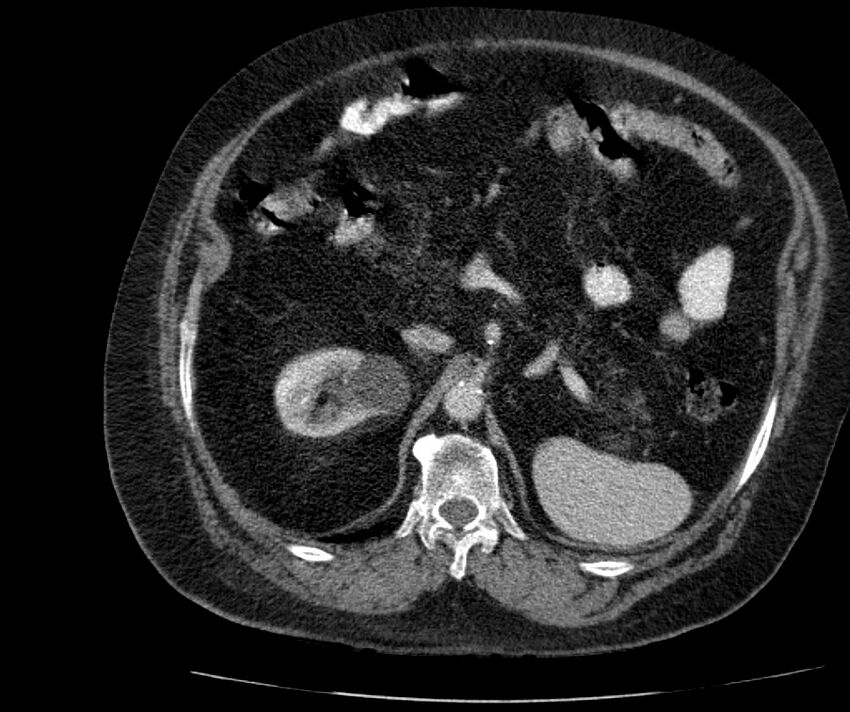 Nephroptosis with inguinal hernia containing perirenal fat (Radiopaedia 56632-63391 C 121).jpg