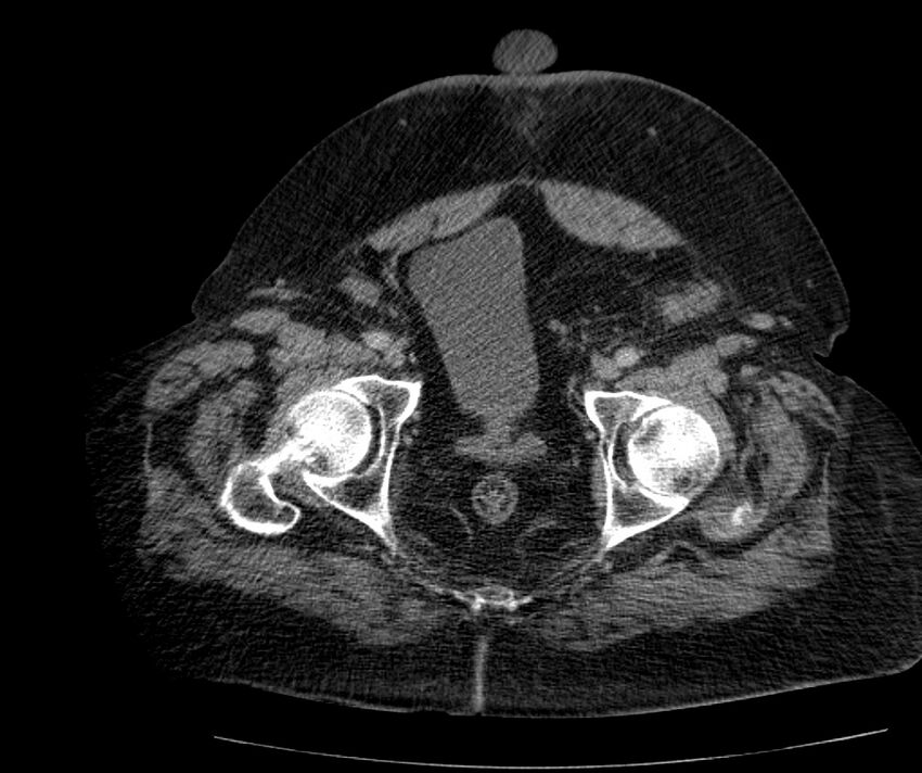 Nephroptosis with inguinal hernia containing perirenal fat (Radiopaedia 56632-63391 C 310).jpg
