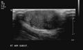 Neurofibromatosis of breast (Radiopaedia 5921-7462 I 1).jpg
