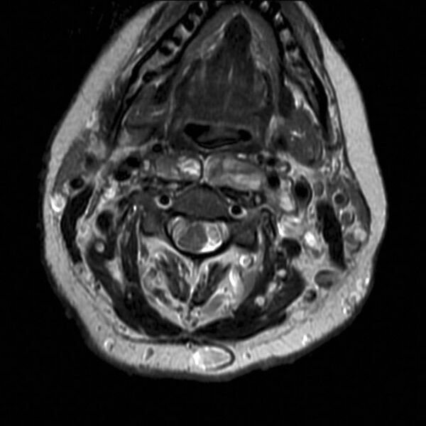 File:Neurofibromatosis type 1 (Radiopaedia 9159-9859 B 1).jpg