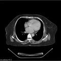 Non-Hodgkin lymphoma (Radiopaedia 27492-27690 A 2).jpg
