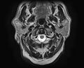 Non-Hodgkin lymphoma - parotid gland (Radiopaedia 71531-81890 Axial T2 16).jpg