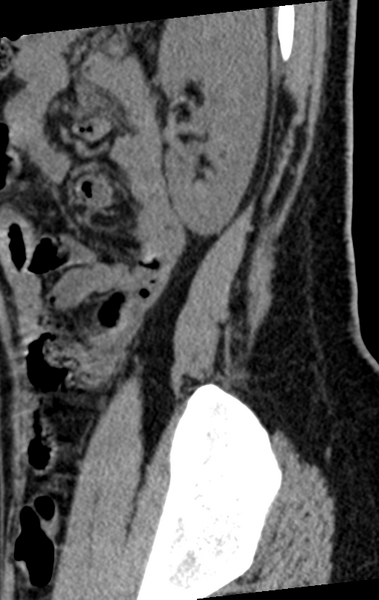 File:Normal lumbar spine CT (Radiopaedia 46533-50986 C 6).png