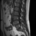 Normal lumbar spine MRI (Radiopaedia 35543-37039 Sagittal T1 8).png