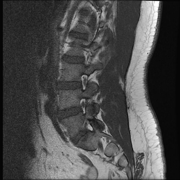 File:Normal lumbar spine MRI (Radiopaedia 43051-46311 Sagittal T1 15).jpg