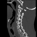 Normal trauma cervical spine (Radiopaedia 41017-43760 Sagittal bone window 15).png
