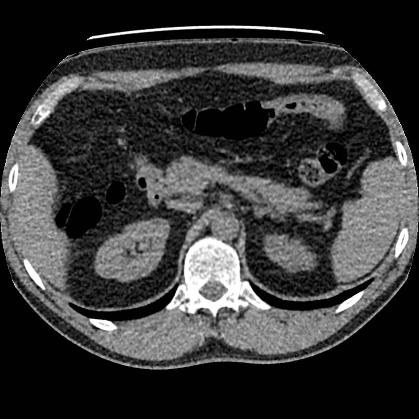 Obstructing ureteric calculus and ureteric anatomy (Radiopaedia 62730-71042 Axial non-contrast 16).jpg