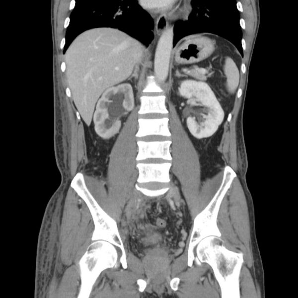 File:Obstructive bladder transitional cell carcinoma (Radiopaedia 9825-10410 B 15).jpg