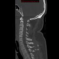 Occipital condyle fracture (Radiopaedia 18366-18208 Sagittal bone window 16).jpg