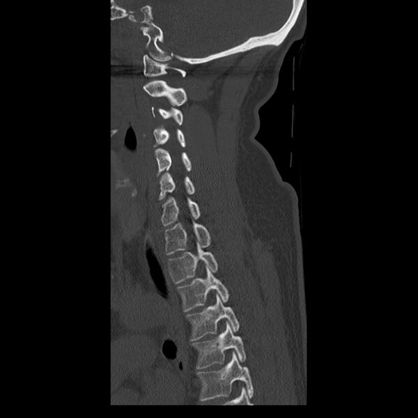 File:Occipital condyle fracture (Radiopaedia 31755-32691 Sagittal bone window 26).jpg