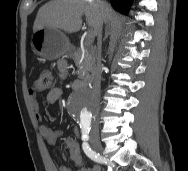 File:Abdominal aortic aneurysm (Radiopaedia 22421-22458 D 15).jpg