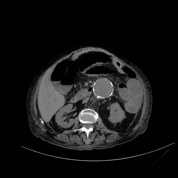 File:Abdominal aortic aneurysm - impending rupture (Radiopaedia 19233-19246 Axial non-contrast 56).jpg