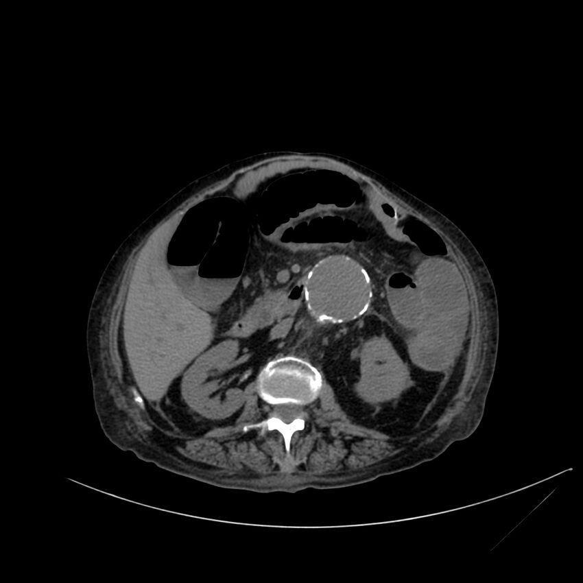 Abdominal aortic aneurysm - impending rupture (Radiopaedia 19233-19246 Axial non-contrast 56).jpg