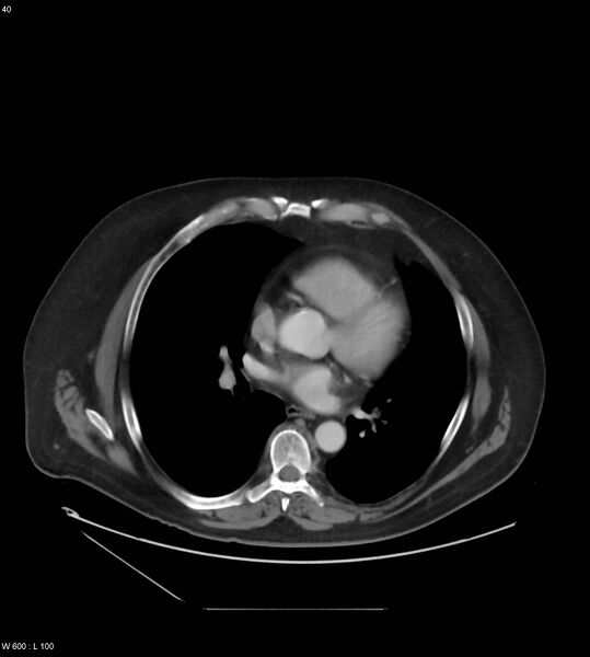 File:Abdominal aortic aneurysm with intramural hematoma then rupture (Radiopaedia 50278-55631 Axial C+ arterial phase 31).jpg
