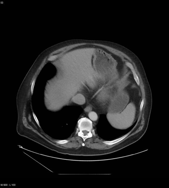 File:Abdominal aortic aneurysm with intramural hematoma then rupture (Radiopaedia 50278-55631 Axial C+ arterial phase 44).jpg