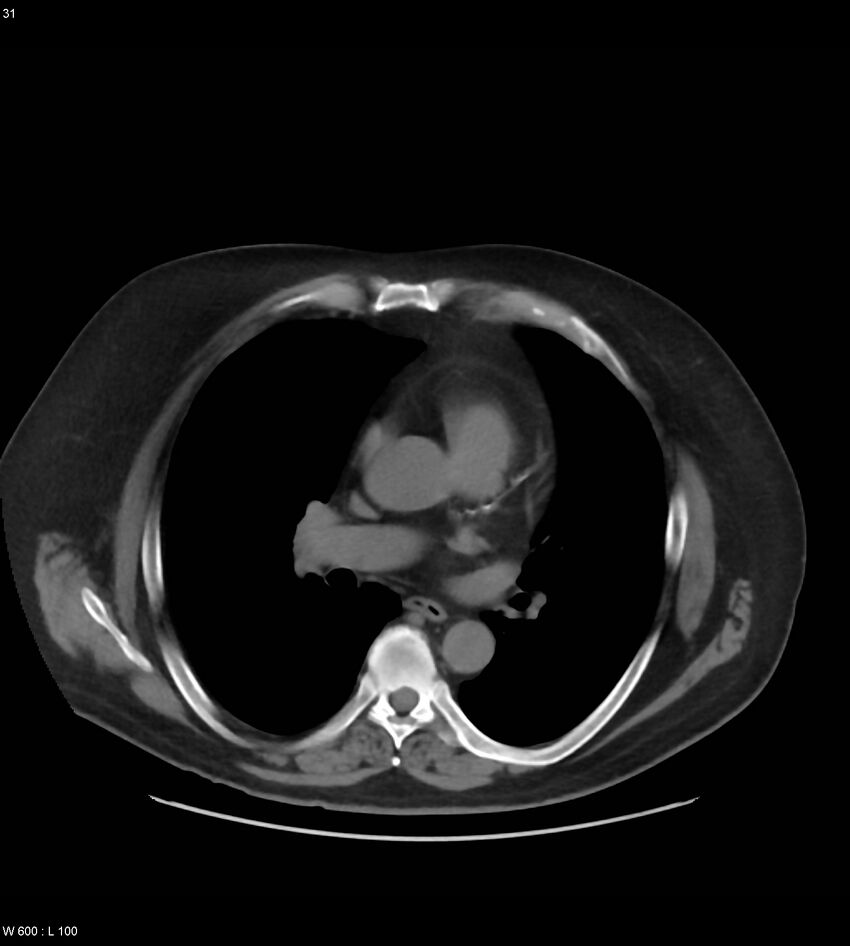 Abdominal aortic aneurysm with intramural hematoma then rupture (Radiopaedia 50278-55631 Axial non-contrast 27).jpg