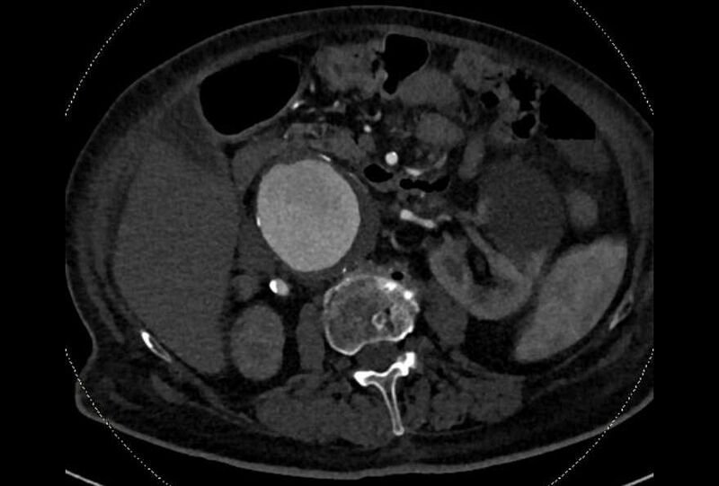 File:Abdominal aortic aneurysm with thrombus fissuration (Radiopaedia 73192-83919 Axial C+ arterial phase 64).jpg