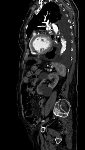 File:Abdominal aortic aneurysm with thrombus fissuration (Radiopaedia 73192-83919 Sagittal C+ arterial phase 40).jpg