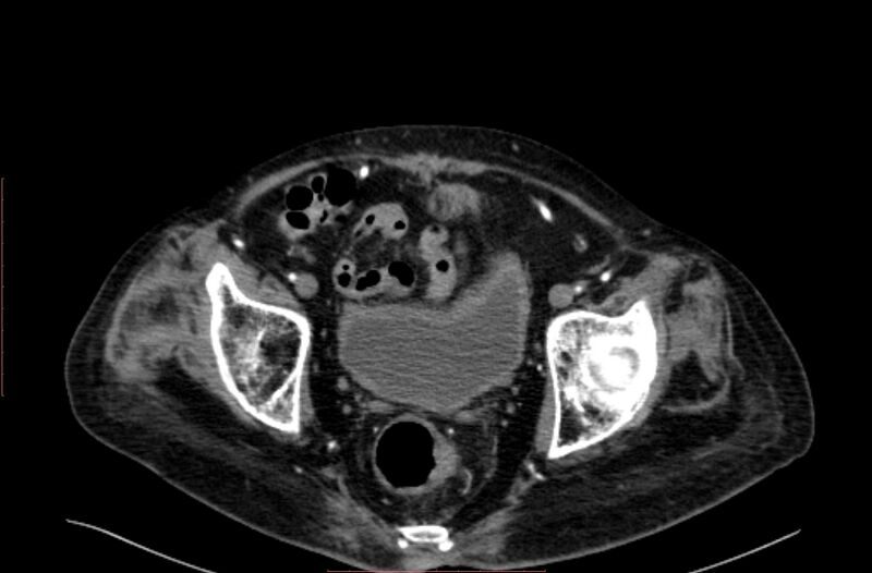 File:Abdominal aortic interposition tube graft and aneurysm thrombosis (Radiopaedia 71438-81857 Axial C+ arterial phase 212).jpg