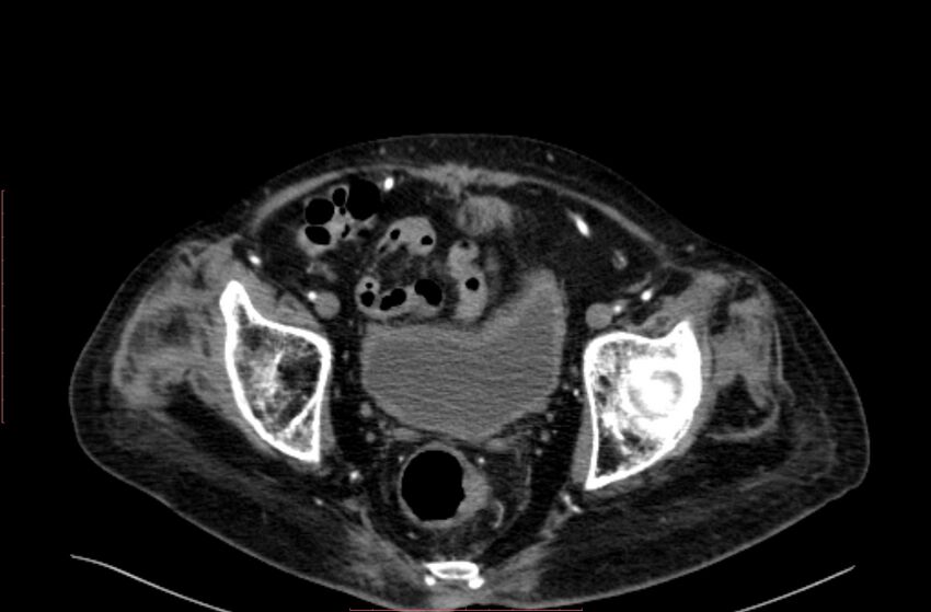 Abdominal aortic interposition tube graft and aneurysm thrombosis (Radiopaedia 71438-81857 Axial C+ arterial phase 212).jpg