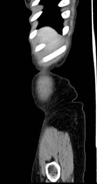 File:Abdominal wall and retroperitoneal tuberculosis (Radiopaedia 88137-104729 Sagittal C+ portal venous phase 140).jpg