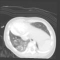 Aberrant left pulmonary artery (pulmonary sling) (Radiopaedia 42323-45435 Axial lung window 30).jpg