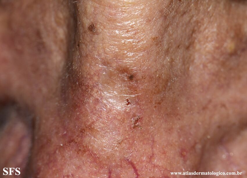 Actinic Keratosis-Atrophic Actinic Keratosis (Dermatology Atlas 2).jpg