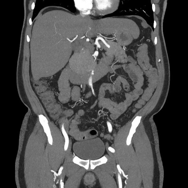 File:Active colonic bleed on CT (Radiopaedia 49765-55025 Coronal art MIP 30).jpg