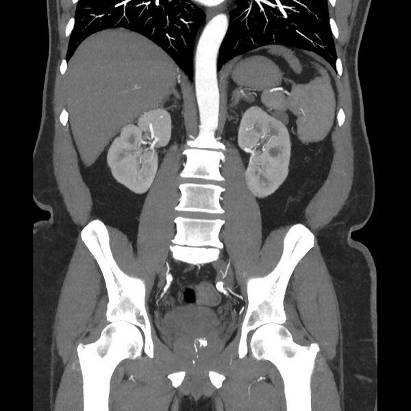 File:Active colonic bleed on CT (Radiopaedia 49765-55025 Coronal art MIP 39).jpg