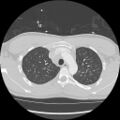 Active right ventricular cardiac sarcoidosis (Radiopaedia 55596-62101 Axial lung window 7).jpg