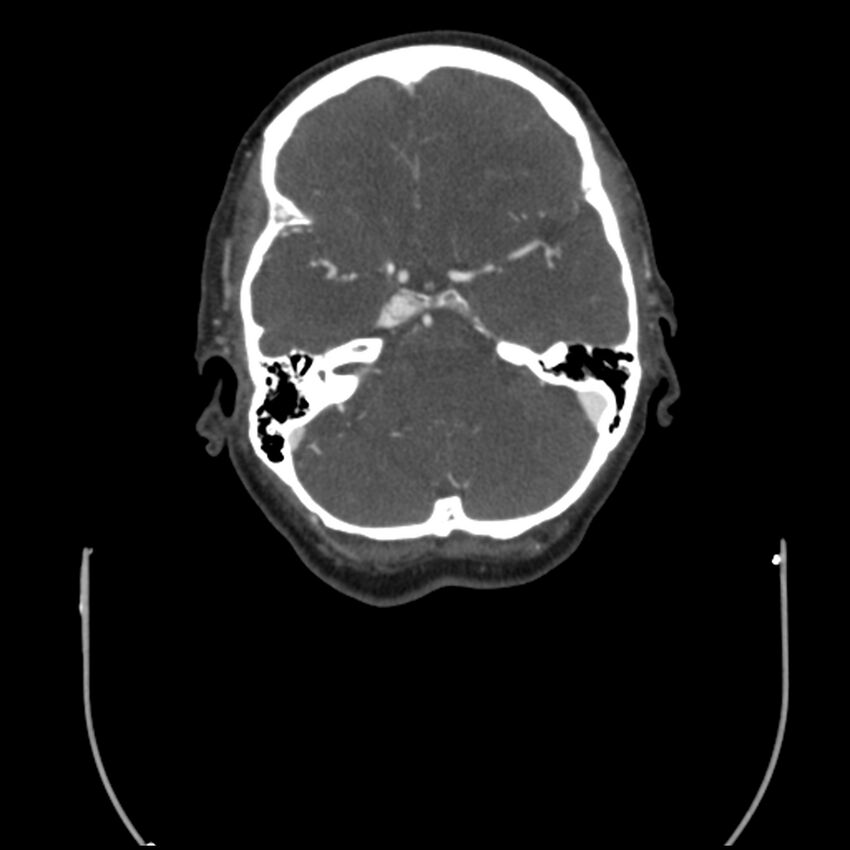 Acute M1 occlusion with ischemic penumbra (CT perfusion) (Radiopaedia 71897-82344 Axial C+ arterial phase thins 103).jpg