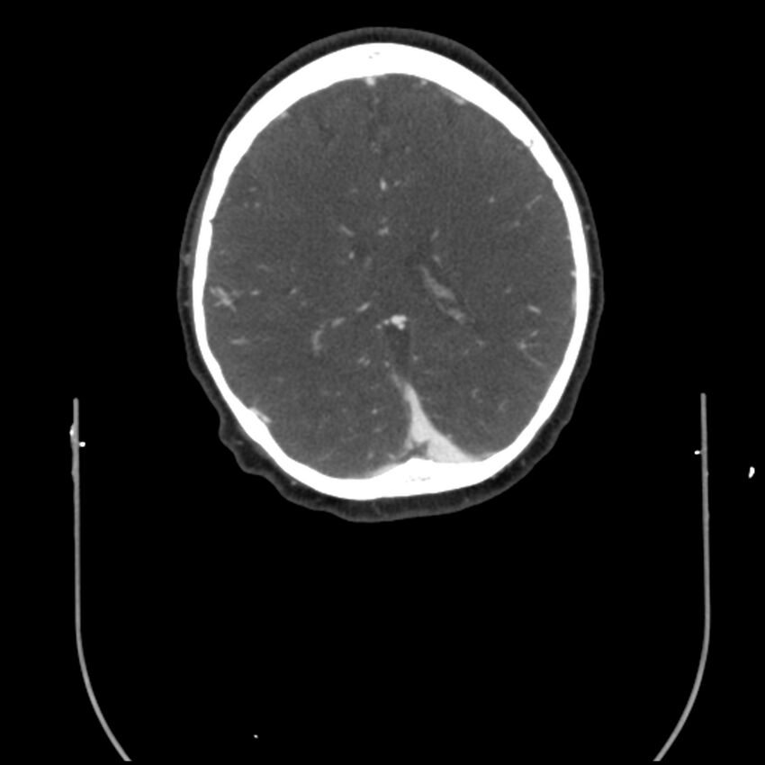 Acute M1 occlusion with ischemic penumbra (CT perfusion) (Radiopaedia 71897-82344 Axial C+ arterial phase thins 28).jpg