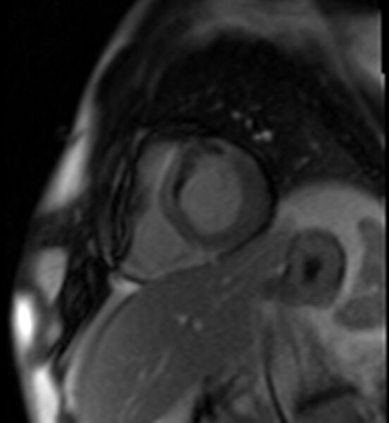 File:Acute anteroseptal myocardial infarction (Radiopaedia 68409-77945 Short axis (basal) Perfusion 44).jpg