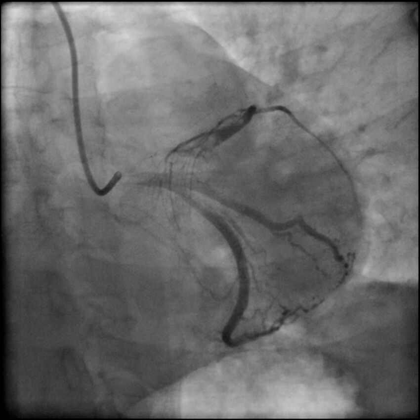 Acute anteroseptal myocardial infarction (Radiopaedia 68409-77946 LAO caudal (spider view) LAD and CX 46).jpg