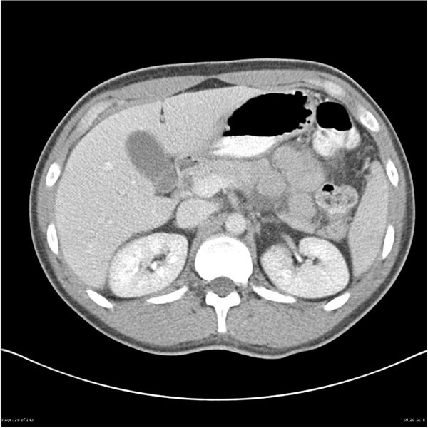 File:Acute appendicitis (Radiopaedia 25364-25615 B 16).jpg