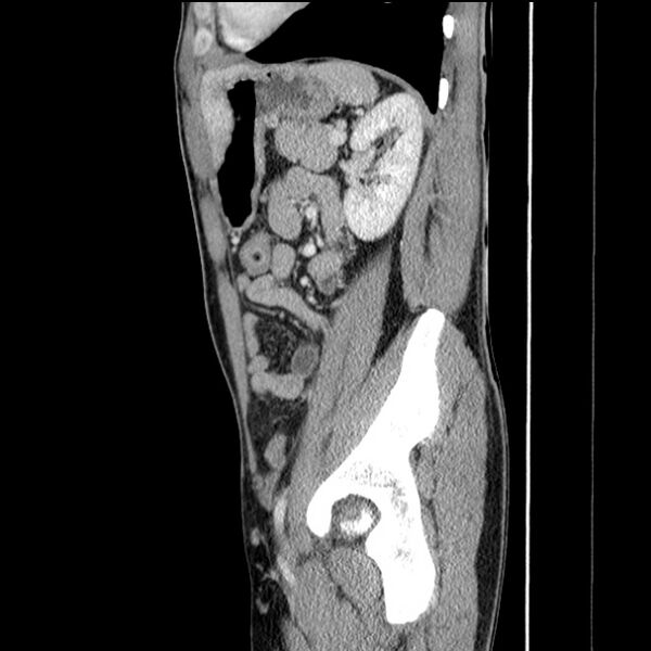 File:Acute appendicitis (Radiopaedia 27049-27227 Sagittal C+ portal venous phase 57).jpg