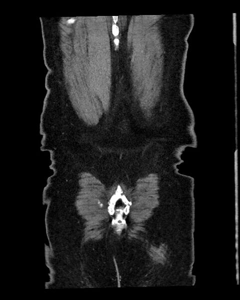 File:Acute appendicitis - large appendicoliths (Radiopaedia 61805-69820 Coronal C+ portal venous phase 126).jpg