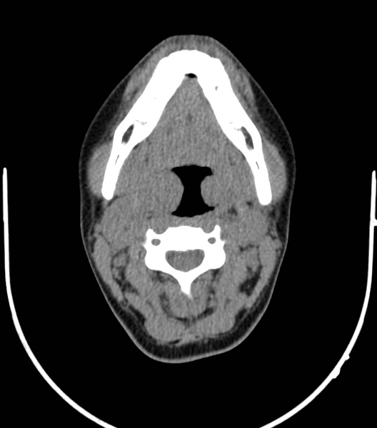 File:Acute bacterial tonsillitis (Radiopaedia 22882-22908 Axial non-contrast 23).png