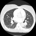 Acute chest syndrome - sickle cell disease (Radiopaedia 42375-45499 Axial lung window 95).jpg