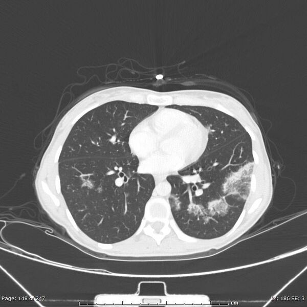 File:Acute eosinophilic pneumonia (Radiopaedia 48211-53073 Axial lung window 53).jpg