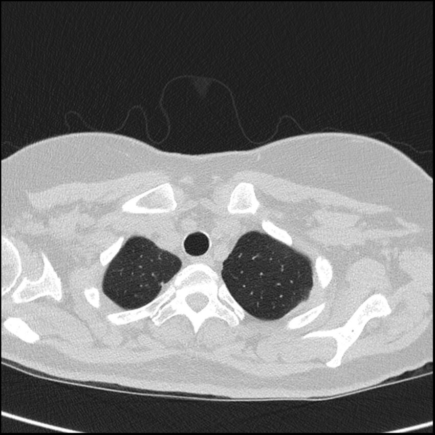 Acute interstitial pneumonitis (Radiopaedia 45404-49453 Axial lung window 11).jpg