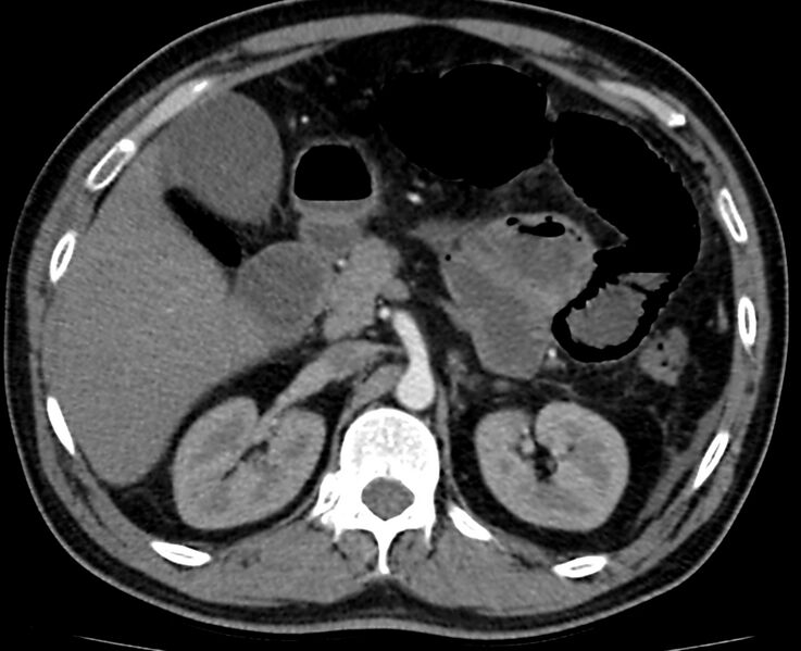 File:Acute mesenteric ischemia - superior mesenteric artery thrombosis (Radiopaedia 73947-84776 Axial C+ arterial phase 24).jpg