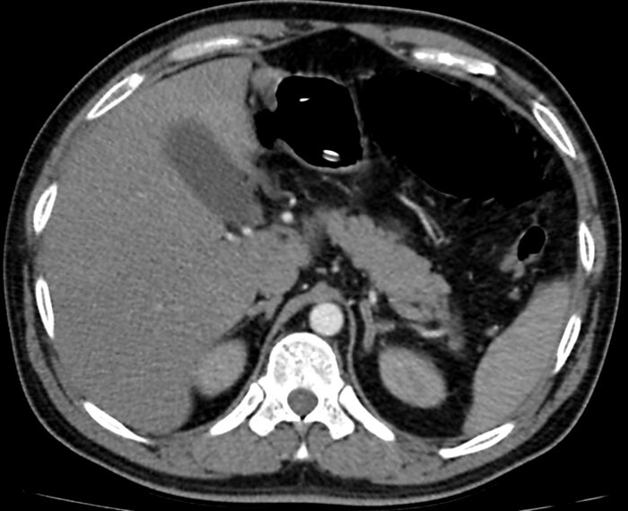Acute mesenteric ischemia - superior mesenteric artery thrombosis (Radiopaedia 73947-84776 Axial C+ arterial phase 6).jpg
