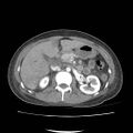 Acute myocarditis (Radiopaedia 55988-62613 Axial C+ portal venous phase 28).jpg
