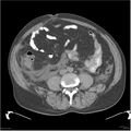 Acute pancreatitis (Radiopaedia 19135-19116 Axial non-contrast 36).jpg