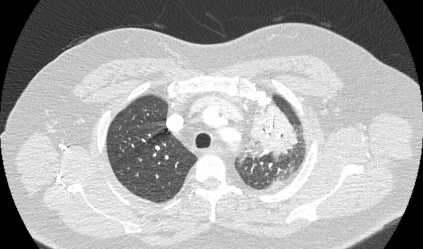 Acute pulmonary embolism with pulmonary infarcts (Radiopaedia 77688-89908 Axial lung window 15).jpg